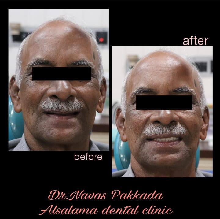 Complete Denture